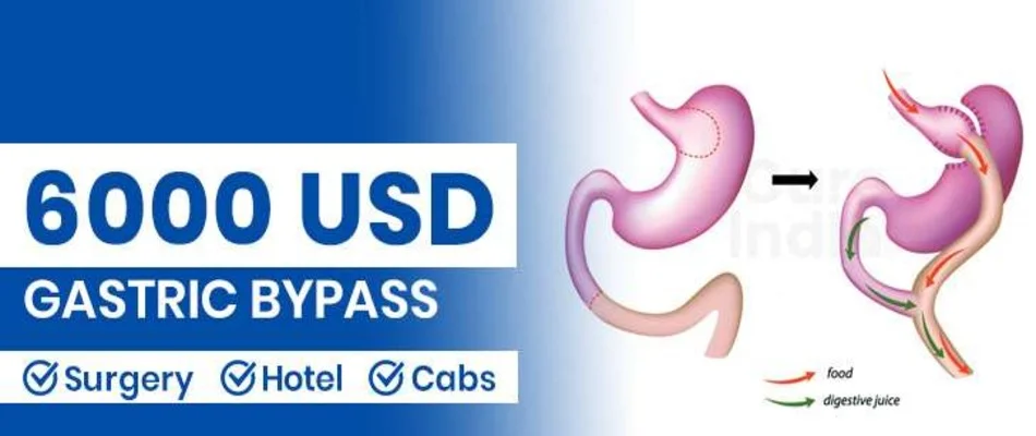 Gastric Bypass Surgery Cost